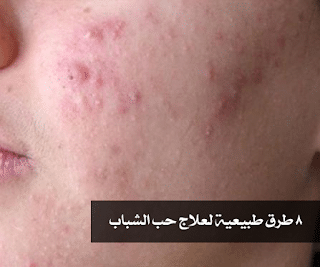 8 طرق طبيعية لعلاج حب الشباب