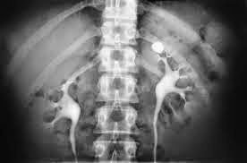 كيف تمنع تكون حصى الكلى؟ 8