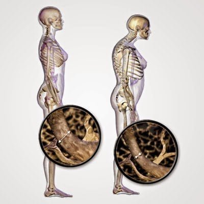 أعراض نقص فيتامين د و أسبابه و طرق علاجه 10