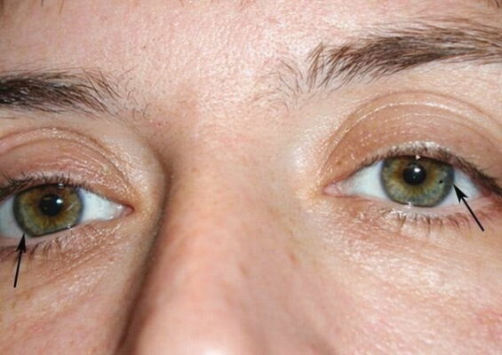 داء ويلسون Wilson disease : الأسباب - الأعراض - العلاج 16