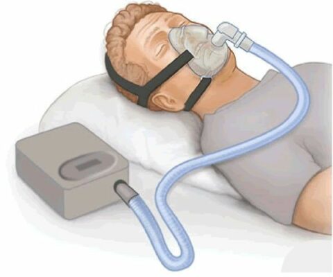 إنقطاع التنفس أثناء النوم و جهاز micro CPAP بدون خراطيم و أسلاك لعلاج المشكلة 4