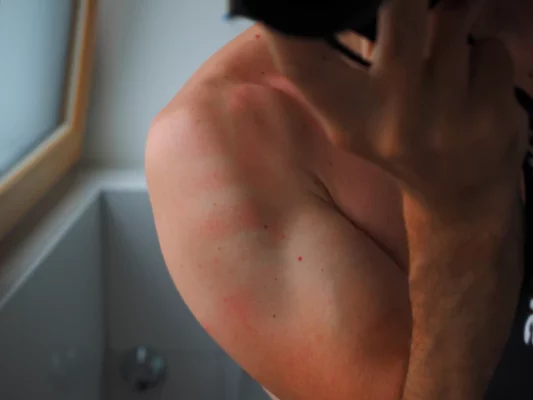 أسباب الحكة بعد الاستحمام و 8 علاجات سريعة لها