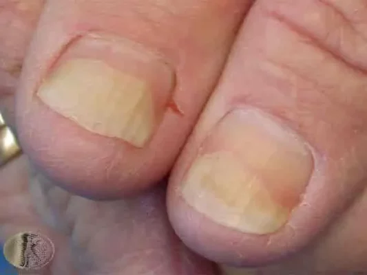 3 أسباب محتملة لسقوط الأظافر 2