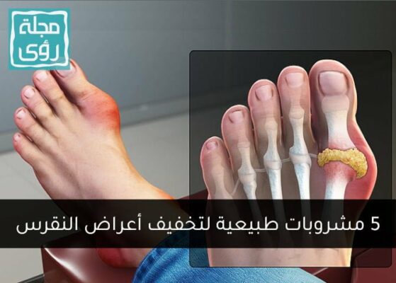 أفضل 5 مشروبات مفيدة للنقرس طبيعية 100% 4